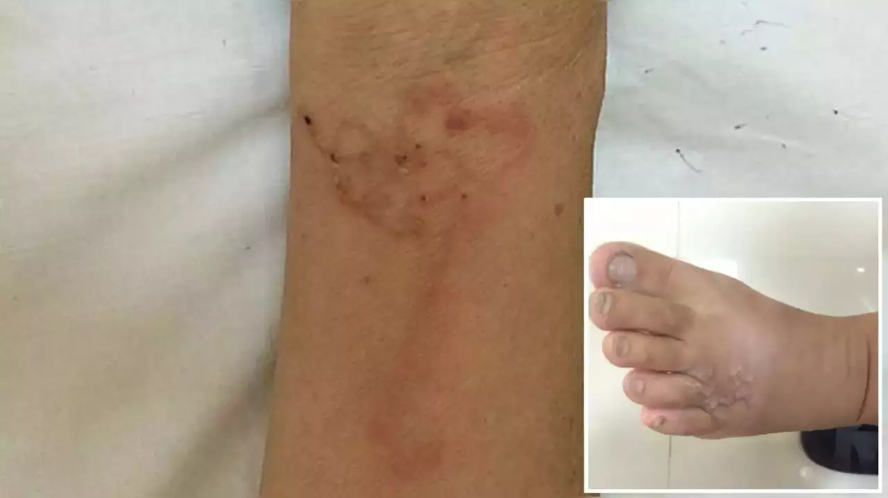 Parasites found under Vietnam woman's skin after she ate raw blood pudding